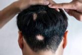 En qué consiste la alopecia areata y cómo disminuirla