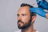 Mesoterapia capilar, tratamiento para la ca�da del pelo