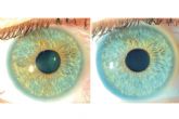 Los heterocromas y los nevus del iris pueden ser tratados con lser segn Clnica Eyecos