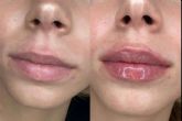 Conseguir unos labios 100 % naturales gracias a la tcnica en dos pasos de la doctora Sandra Hermida