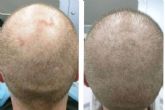 Las ventajas de la micropigmentacin capilar, por Dermopigmentacin Clnica