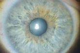La revolucionaria iridoplastia l�ser en la Cl�nica Eyecos. Cambio de color de ojos seguro, efectivo y natural