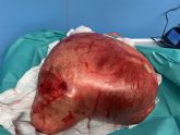 Dr. Koldo Carbonero y el equipo de Quirnsalud Gipuzkoa consiguen extirpar un quiste ovrico de 8 kilos de peso