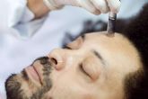 Malecare informa sobre el microneedling facial y capilar