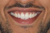 Los servicios de blanqueamientos dentales de la Cl�nica Zahara