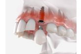 Las ventajas de un implante dental en DeltaDent