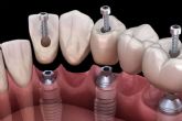 ?D�nde encontrar un servicio de colocaci�n de implantes? Dental Implantologie