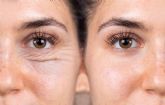 Centro M�dico El Pilar lleva a cabo la cirug�a blefaroplastia