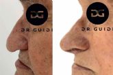 El Dr. Guidi ofrece tratamientos de rinomodelaci�n en su cl�nica