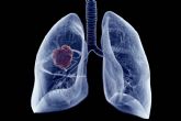 El tratamiento de c�ncer de pulm�n con Oncothermia (Nanothermia)