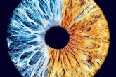 ?Qu son las heterocromas congnitas?, por Eyecos