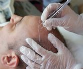 El pelo propio es la elecci�n m�s segura y natural para el trasplante capilar��