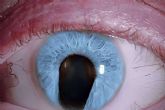El tratamiento del coloboma del iris es �nicamente quir�rgico