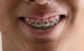 El 21% de la poblaci�n tiene como objetivo alinear sus dientes en los pr�ximos 12 meses