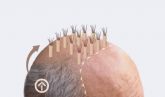 Ventajas de la t�cnica FUE Zafiro HD para recuperar el pelo, por Doctor Jes�s An�bal Mora