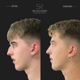 La Dra. Silvia Ros�n advierte sobre el riesgo creciente en la rinoplastia: el �cido hialur�nico puede causar complicaciones graves en cirug�a nasal