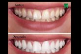 La importancia de una sonrisa radiante; Blanqueamiento dental en dos citas