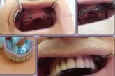 Madrid conf�a en Cl�nica Jorge del Corral para implantes dentales de excelencia