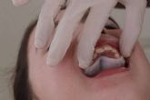 Smart Aligner Services, Pioneer in Europe's First Event on Invisalign Palatal Expander