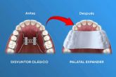 Doctores murcianos lideran la revolucin en ortodoncia con expansores plsticos innovadores