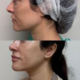 El Microlifting o lifting de fin de semana llega a Espana de la mano del Dr. Albert Bosch