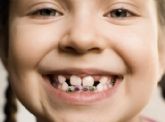 El Centre Dental Francesc Macia explica en qu� consiste un tratamiento de ortodoncia infantil y sus posteriores beneficios