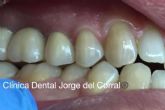 Prtesis fija esttica de zirconio; la apuesta de Clnica Dental Jorge del Corral por la calidad y la esttica dental