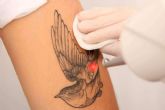 360Clinics revoluciona la eliminacin de tatuajes con picolaser, un mtodo eficaz y seguro