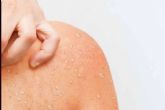 Verano y hongos en la piel; claves para reconocer y tratar la micosis