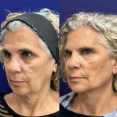 Global Face: nuevo protocolo integral del Dr. Ángel Martín para la recuperación de estructuras faciales, de la firmeza y elasticidad dérmica