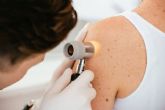 M�s all� de la crema solar: la importancia de revisar manchas y lunares