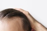 La testosterona y su relaci�n con la aparici�n de la alopecia androgen�tica, presente hasta en un 70% de los hombres