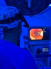 El hospital Santa Luca aplica con xito una tcnica pionera en la Regin para tratar el cncer de pulmn