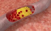 Arroz de levadura roja, un suplemento para las hipercolesterolemias leves y moderadas