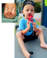 Una acci�n de Vithas Internacional y el Dr. Sol�s permite que un nino de tres anos sea intervenido y pueda empezar a comer por s� mismo