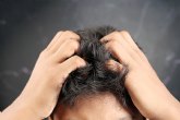 La psoriasis y su relaci�n con la ca�da del cabello