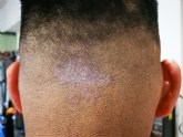 Tinea capitis, una infecci�n del cuero cabelludo en ascenso en Espana desde el ano 2021