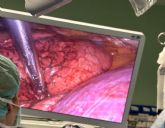 La Arrixaca comienza a aplicar una novedosa tcnica en la Regin para tratar pequenos tumores de difcil acceso