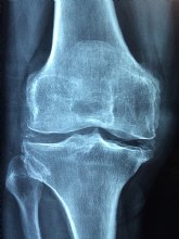 Mesa redonda sobre ´nuevas dianas terapéuticas en osteoporosis y vitamina d´