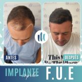 &iquest;P�rdida de cabello? Mediarte ofrece resultados con una efectividad del 95%