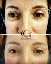 Relleno de cuenca orbitaria con cido hialurnico para rejuvenecer la mirada: en qu consiste este novedoso tratamiento en Espana