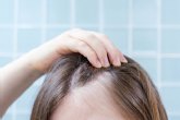 ?Tener entradas significa necesariamente sufrir alopecia?